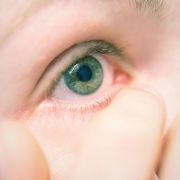 Wenn die Lidränder gereizt sind, sollten Betroffene ihre Augen nicht schminken. Wenn die Lidränder gereizt sind, sollten Betroffene ihre Augen nicht schminken.