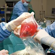 In England wurde einer Teenagerin ein Tumor mit Haaren, Zähnen und Gehirnzellen entnommen! (Symbolfoto) In England wurde einer Teenagerin ein Tumor mit Haaren, Zähnen und Gehirnzellen entnommen! (Symbolfoto)