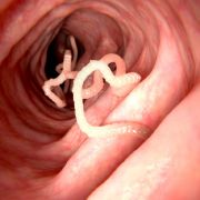 Ein Chinese hatte 15 Jahre lang einen Bandwurm in seinem Körper. Ein Chinese hatte 15 Jahre lang einen Bandwurm in seinem Körper.