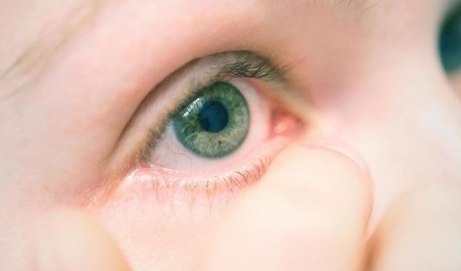 Wenn die Lidränder gereizt sind, sollten Betroffene ihre Augen nicht schminken.