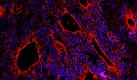 So sieht er aus: Fluoreszenzfärbung eines Darmkrebs-Gewebeschnittes. Foto: idw