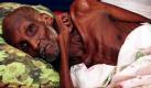 Abdi Ibrahim leidet unter Mangelernährung. Der Osten Afrikas wird von der schlimmsten Dürre seit 60 Jahren bedroht. Elf Millionen Menschen in Kenia, Somalia und Äthopien sind betroffen. Die UNO warnt vor einer riesigen Hungerkatastrophe und ruft zu Spenden auf. Foto: dapd