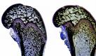 Bei Osteoporose werden gesunde Knochen (l.) brüchig (r.). Untergewichtige und Raucher haben ein höheres Erkrankungsrisiko. (Bild: dpa/tmn) Foto: dpa