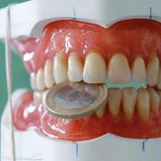 Kronen, Brücken, Implantate (Foto)