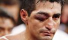 Ein Veilchen schmückt das Gesicht des mexikanischen Profiboxers Erik Morales. Verpasst hat es ihm Marcos Rene Maidana während eines Duells in Las Vegas. Maidana machte bei dem Kampf seinem Spitznamen mal wieder alle Ehre. Er wird KO-Schläger genannt. Foto: dapd