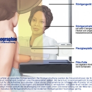 So läuft eine mammographische Untersuchung der Brust ab.
