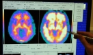 Alzheimer ist eine Erkrankung des Gehirns. Diese Hirnaufnahmen zeigen das Gehirn eines gesunden (links) und eines kranken Patienten. Foto: dpa