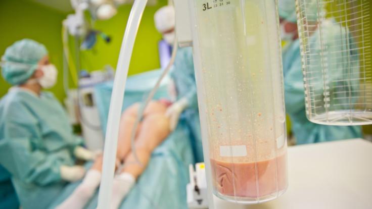 Geht es nach Jens Spahn, müssen Fettabsaugungen bald in speziellen Fällen von den Krankenkassen bezahlt werden.