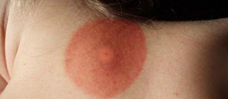 Borreliose  (Foto)