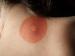 Borreliose  (Foto)