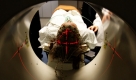 Ein Patient wird in dem Universitätsklinikumin Liege, Belgien, untersucht. Der Belgier Rom Houben lag seit 23 Jahren mit einer falschen Diagnose im Koma, bis ein Arzt vor drei Jahren feststellte, dass sein Gehirn noch funktionierte. Seit 1983 liegt der Patient nach einem Autounfall im Koma. Foto: ap