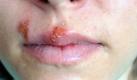 Erst ein leichtes Jucken, doch ein paar Stunden später haben Herpesbläschen die Lippe fest im Griff. Foto: wikipedia/WarXboT/creative commons licence