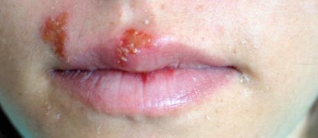 Lippenherpes (Foto)