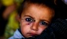 Ein Ausbruch der Tropenkrankheit Kutane Leishmaniasis sucht Afghanistan heim. Die kutane Leishmaniose (auch bekannt als Orient-beule) befällt die Haut und verursacht schmerzhafte Geschwüre. Die Übertragung findet durch Sand- bzw. Schmetterlingsmücken statt, welche die Krankheitserreger Leishmanien übertragen. Nach Angaben der Weltgesundheitsorganisation sind mehr als 13 Millionen Menschen betroffen. Foto: dapd