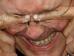 Bindehautentzündung (Foto)