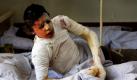 Ein Opfer des Nato-Luftangriffs in Kundus liegt in einem Krankenhaus in Kabul, Afghanistan. Bei dem Luftangriff in Kundus sind nach Recherchen des Bremer Opferanwalts Karim Popal mindestens 137 Zivilisten getötet worden.  Foto: ap