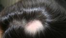 Die Alopecia areata hat ein typisches Aussehen: Die haarlosen Kreise sind scharf abgegrenzt. (Bild: www.haarerkrankungen.de/dpa/tmn) Foto: dpa