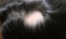 Die Alopecia areata hat ein typisches Aussehen: Die haarlosen Kreise sind scharf abgegrenzt. Foto: dpa