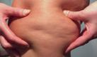 Die unschönen Dellen - auch so nett als Orangenhaut bezeichnet - sind für Frauen ein rotes Tuch. Anstatt sich damit abzufinden, kämpfen sie mit allen Mittel gegen die Cellulite an. Aber was hilft wirklich? Foto: ddp