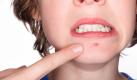 Viele Frauen, die die Anti-Baby-Pille absetzen, haben mit Pickeln, fettigen Haaren und unregelmäßigen Zyklen zu kämpfen. Foto: istockphoto