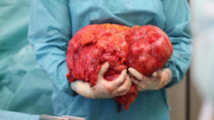 Der Tumor brachte stolze 15 Kilo auf die Waage.