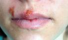 Er verbirgt sich im Untergrund. Und gerade, wenn das Immunsystem angeknackst ist, schlägt er gnadenlos zu: der Herpes. Das Schlimme: Einmal an der Lippe, verfolgt er einen das ganze Leben lang. Doch es gibt eine Abwehrstrategie gegen die Virenplage. Foto: Wikipedia/WarXboT/creative commons licence