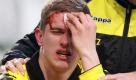 Mit schmerzverzerrtem Gesicht versucht Dortmunds Sven Bender, die Blutung am Kopf zu stillen. Die Verletzung zog er sich beim Dortmunder 3:0-Sieg in Wolfsburg im Januar 2011 zu. In dieser Saison musste Bender dann auch noch einen Kieferbruch überstehen. Foto: dapd