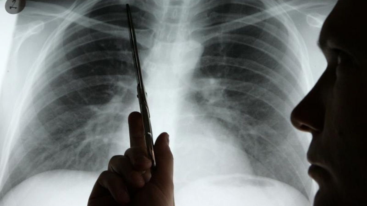 Durch das neue Inhaliermedikament erhoffen sich Wissenschaftler höhere Heilungschancen bei Lungenkrebs. (Foto)
