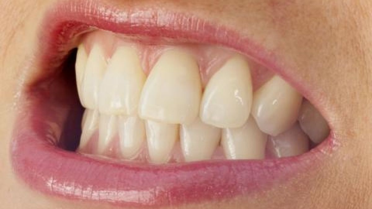 Tagsüber wird gepresst, nachts geknirscht: Ein schmerzender Kiefer oder sogar abgeriebene Zähne sind die Folgen.  (Foto)