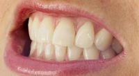 Tagsüber wird gepresst, nachts geknirscht: Ein schmerzender Kiefer oder sogar abgeriebene Zähne sind die Folgen. 