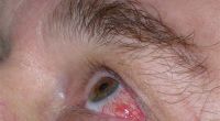 Die Entzündung der Blutgefäße ist eine Erkrankung, die sich überall im Körper ausprägen kann - auch an den Augen.