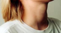 Eine vergrößerte Schilddrüse, der sogenannte Kropf, kann ein Anzeichen für eine Unterfunktion sein.