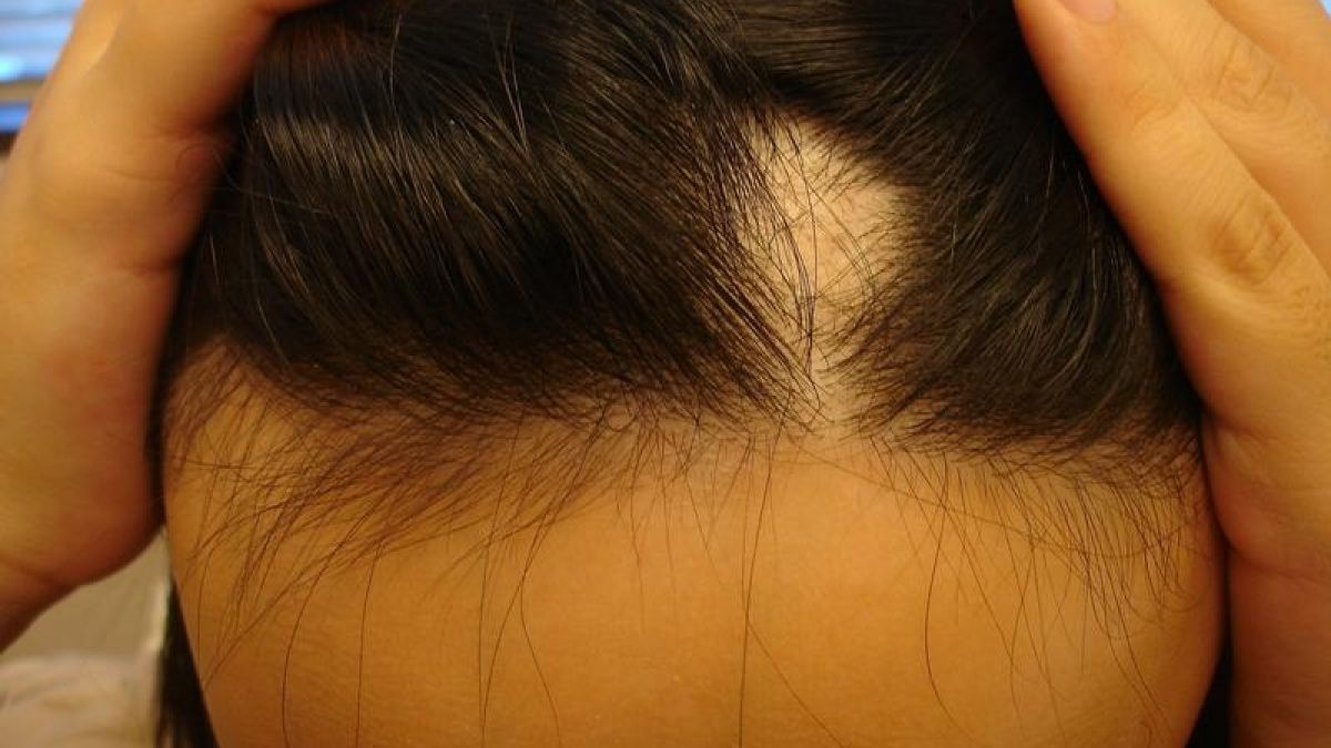 Leerstelle: Verliert ein Mensch an die 100 Haaren pro Tag, wird es bedenklich. (Foto)