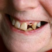 Der Verlust der Beißerchen Der Verlust der Beißerchen