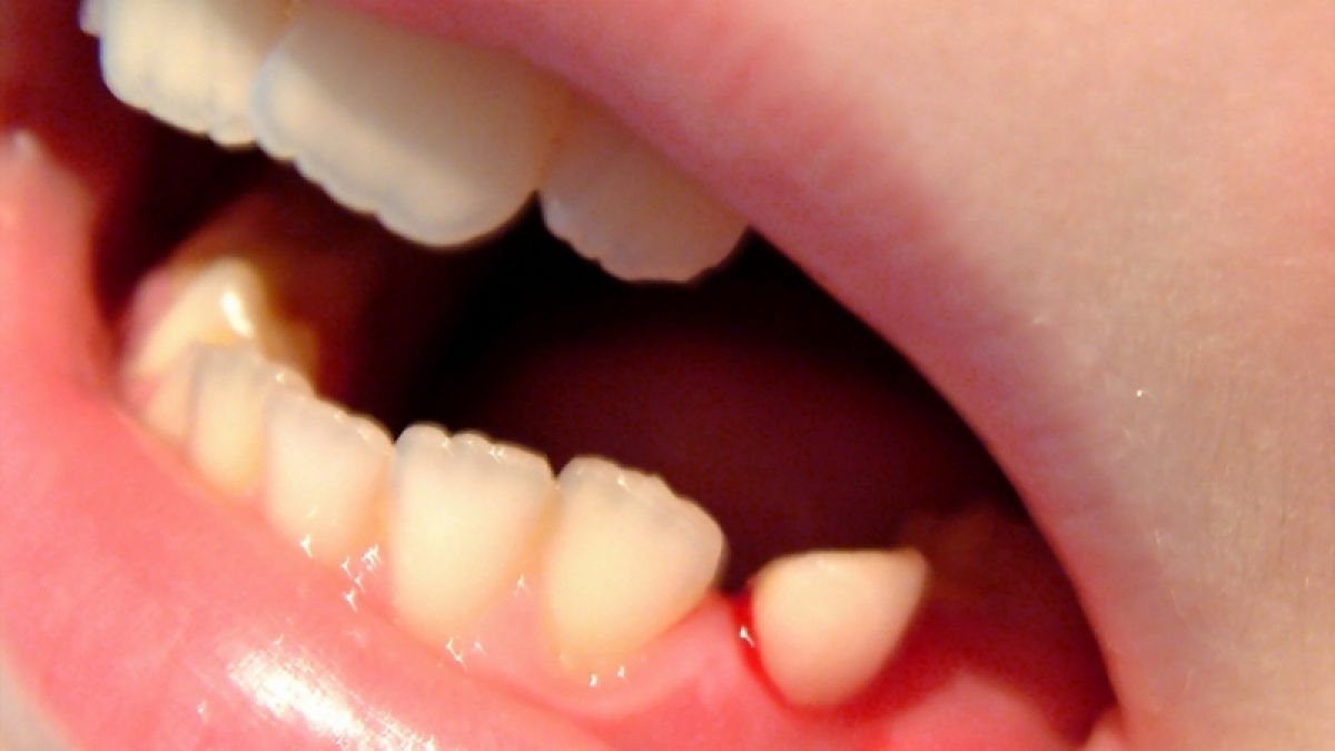 Zahnfleischbluten ist an sich nicht schlimm, kann aber ein Symptom für Parodontitis sein. (Foto)