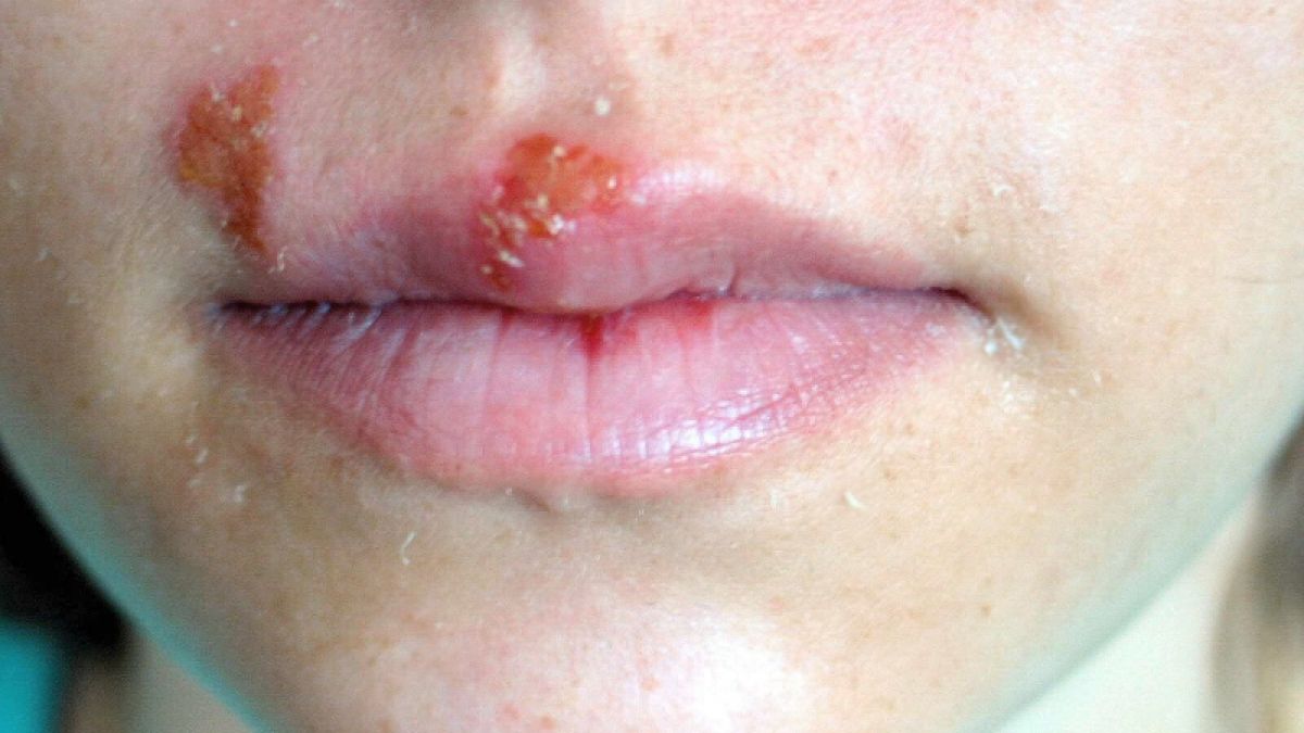 Erst ein leichtes Jucken, doch ein paar Stunden später haben Herpesbläschen die Lippe fest im Griff. (Foto)