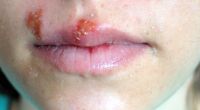 Erst ein leichtes Jucken, doch ein paar Stunden später haben Herpesbläschen die Lippe fest im Griff.