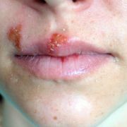 Er verbirgt sich im Untergrund. Und gerade, wenn das Immunsystem angeknackst ist, schlägt er gnadenlos zu: der Herpes. Er verbirgt sich im Untergrund. Und gerade, wenn das Immunsystem angeknackst ist, schlägt er gnadenlos zu: der Herpes.