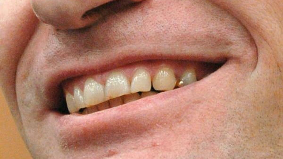 Diese Zähne zerkauten Menschenfleisch: Sie sitzen im Mund vom Armin Meiwes, auch bekannt als Kannibale von Rotenburg.  (Foto)