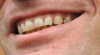 Diese Zähne zerkauten Menschenfleisch: Sie sitzen im Mund vom Armin Meiwes, auch bekannt als Kannibale von Rotenburg. 