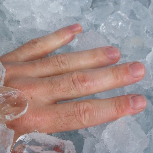 Coole Lösung! Bei Quetschungen ist Kühlung die effektivste Therapie.