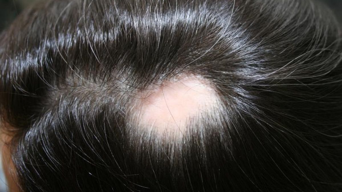 Die Alopecia areata hat ein typisches Aussehen: Die haarlosen Kreise sind scharf abgegrenzt. (Foto)
