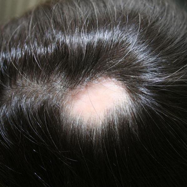 Die Alopecia areata hat ein typisches Aussehen: Die haarlosen Kreise sind scharf abgegrenzt.