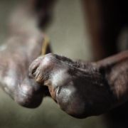 Dabei wollte die Weltgesundheitsorganisation WHO die bakterielle Infektionskrankheit bis 2005 endgültig besiegen, musste jedoch aufgeben. Weiterhin gibt jährlich hunderttausende neue Fälle bei einer hohen Dunkelziffer. Dabei wollte die Weltgesundheitsorganisation WHO die bakterielle Infektionskrankheit bis 2005 endgültig besiegen, musste jedoch aufgeben. Weiterhin gibt jährlich hunderttausende neue Fälle bei einer hohen Dunkelziffer.
