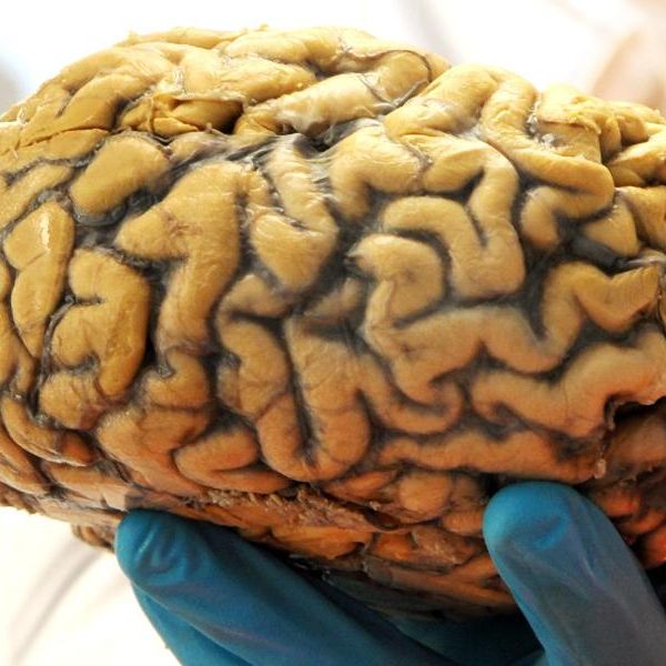 26-Jährige hat Zwillings-Embryo im Gehirn