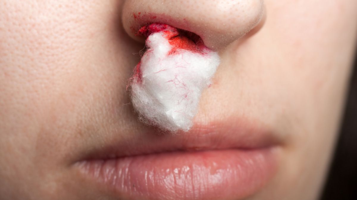 Nasenbluten ist nervig - umso wichtiger, dass es schnell gestoppt wird. (Foto)