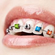 Nette Idee, aber totaler Quatsch: Microsoft kündigte am 1. April einen Zahnspange an, die Fotos machen und per Bluetooth übertragen kann. Nette Idee, aber totaler Quatsch: Microsoft kündigte am 1. April einen Zahnspange an, die Fotos machen und per Bluetooth übertragen kann.