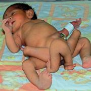 Sogar sechs Beine wachsen aus dem Unterleib dieses Babys, das 2012 in Pakistan zur Welt kam. Sogar sechs Beine wachsen aus dem Unterleib dieses Babys, das 2012 in Pakistan zur Welt kam.