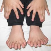 15 Finger, 16 Zehen: So viele Finger und Zehen wie bei diesem kleine Junge aus dem Nordosten Chinas wurden zuvor noch nie bei einem Menschen gezählt. 15 Finger, 16 Zehen: So viele Finger und Zehen wie bei diesem kleine Junge aus dem Nordosten Chinas wurden zuvor noch nie bei einem Menschen gezählt.