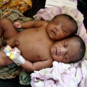 Siamesische Zwillinge überleben selten - doch es ist möglich, mit zwei Köpfen durchs Leben zu gehen.